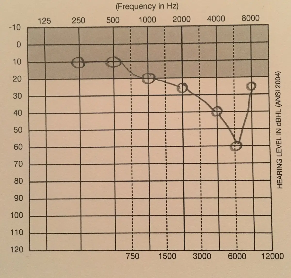 Example audiogram chart showing hearing test results